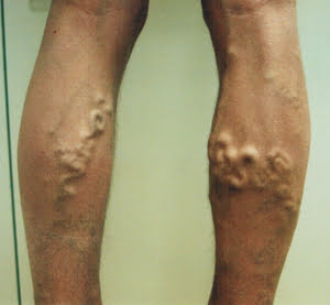 Stacked Leg Veins