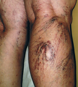The importance of getting your spider veins treated properly with Sclerotherapy
