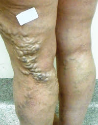 Treatment of Varicose Veins - What's New? The Leg Vein Clinic, Gold Coast