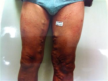 Surgery: No longer the best option for treating varicose veins