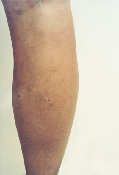 Varicose Vein Treatment, Gallery of before and after treating
