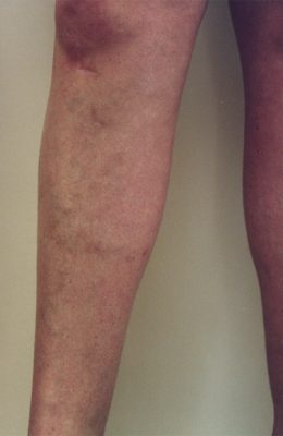varicose veins after treatment patient3 - Vein Doctors Group