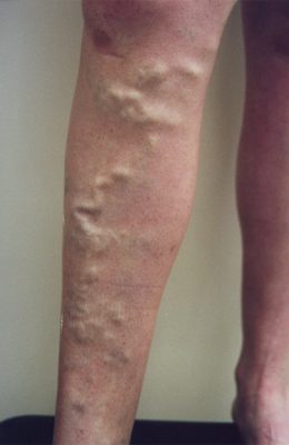 varicose veins before treatment patient3 - Vein Doctors Group
