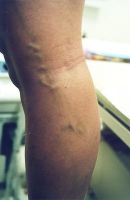 varicose veins before treatment patient4 - Vein Doctors Group