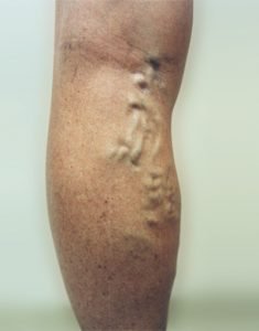 varicose veins before treatment patient5 - Vein Doctors Group