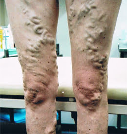 Why you should get your varicose or spider veins treated?