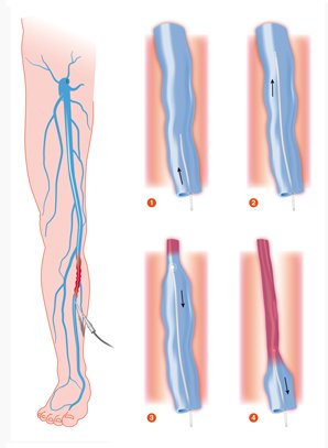 Radiofrequency Ablation and Endovenous Laser Ablation vein treatment techniques