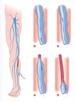 Laser Treatment vs. Surgery: Choosing a Varicose Veins Treatment